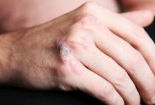 פסוריאזיס – לא מה שחשבתם