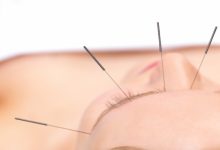 דיקור קוסמטי לפנים - מה היא אקופונקטורה קוסמטית?