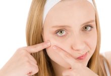 טיפול טבעי באקנה בעזרת רפואה סינית